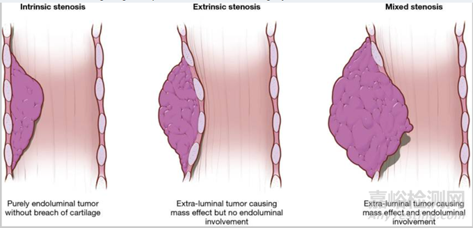 【創(chuàng)新醫(yī)械】Airiver肺部藥物涂層球囊獲FDA突破性認(rèn)定